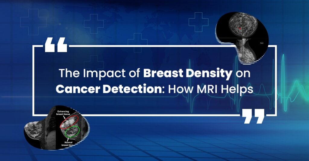 The Impact of Breast Density on Cancer Detection: How MRI Helps